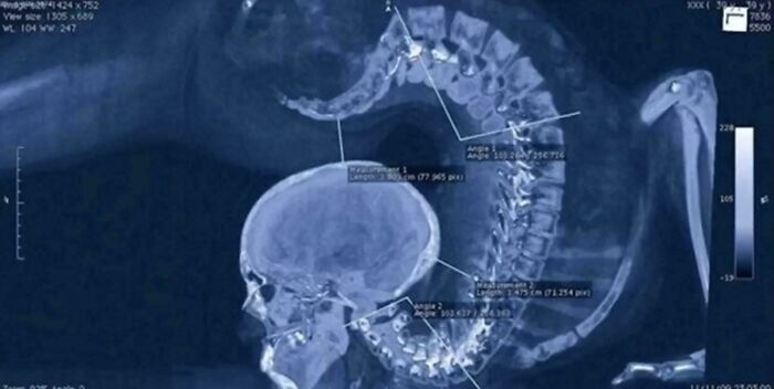X-ray image of a human spine and skull with medical measurements, showcasing fascinating medical photos detail.