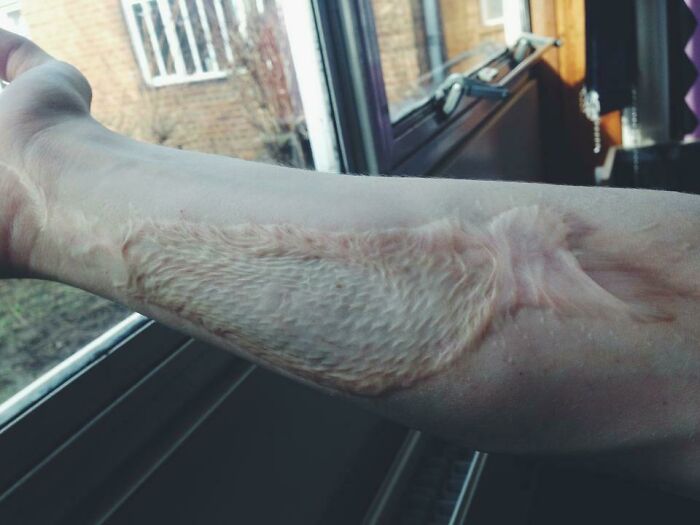 Forearm with a detailed keloid scar resembling fish scales, showcasing a fascinating and disturbing medical photo.