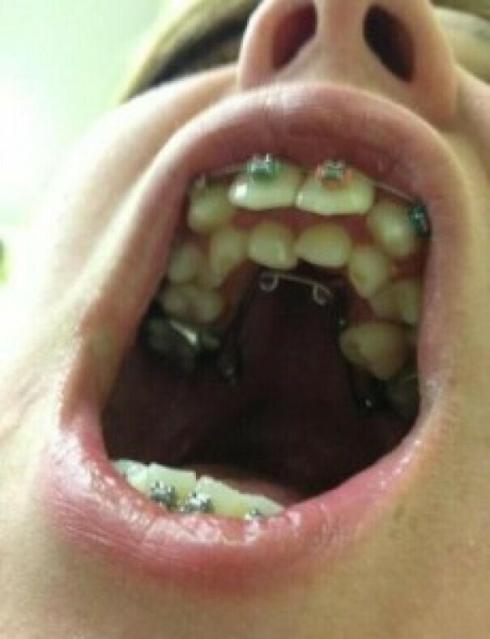 Close-up of a mouth with braces showing misaligned teeth in a medical photo revealing dental conditions.