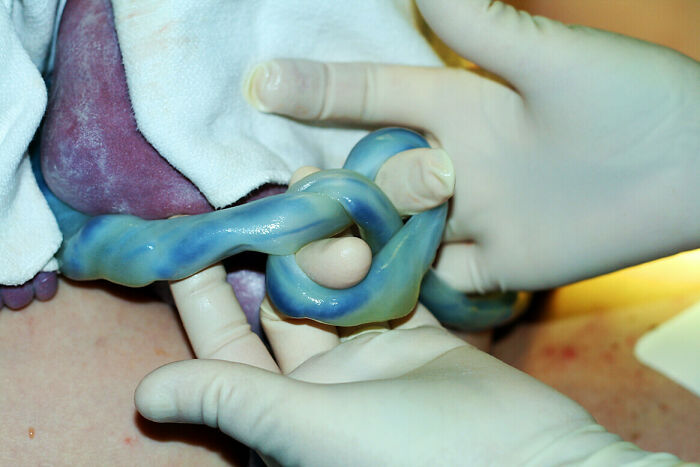 Blue twisted umbilical cord held by gloved hands during medical procedure, showing fascinating medical photo details.