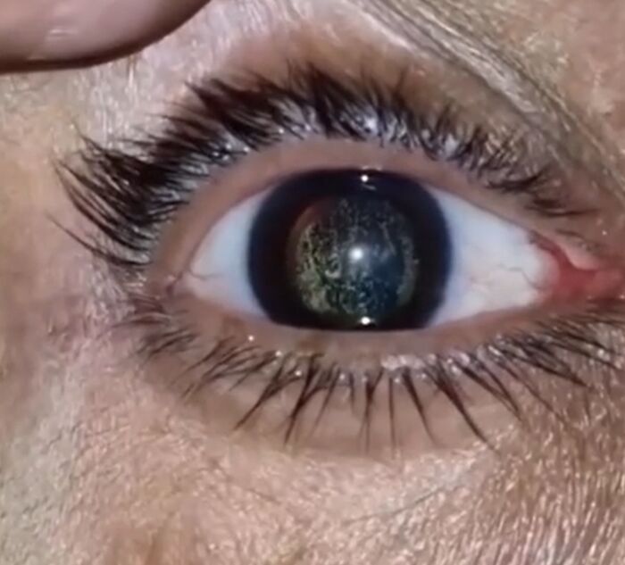 Close-up medical photo of a human eye with an abnormal pupil illustrating fascinating and disturbing medical conditions.