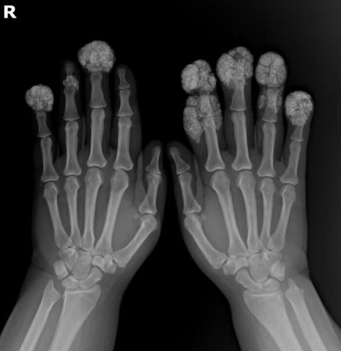 X-ray of hands showing severe bone and joint deformities with abnormal growths, a disturbing medical condition photo.