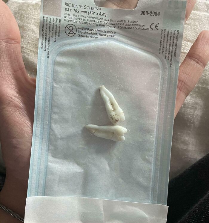 Two extracted human teeth placed on sterile medical packaging held in a hand, a fascinating medical photo.