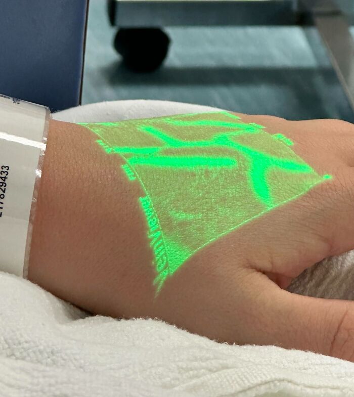 Hand with hospital wristband showing glowing green vein map projection, a fascinating medical photo of vein visualization.