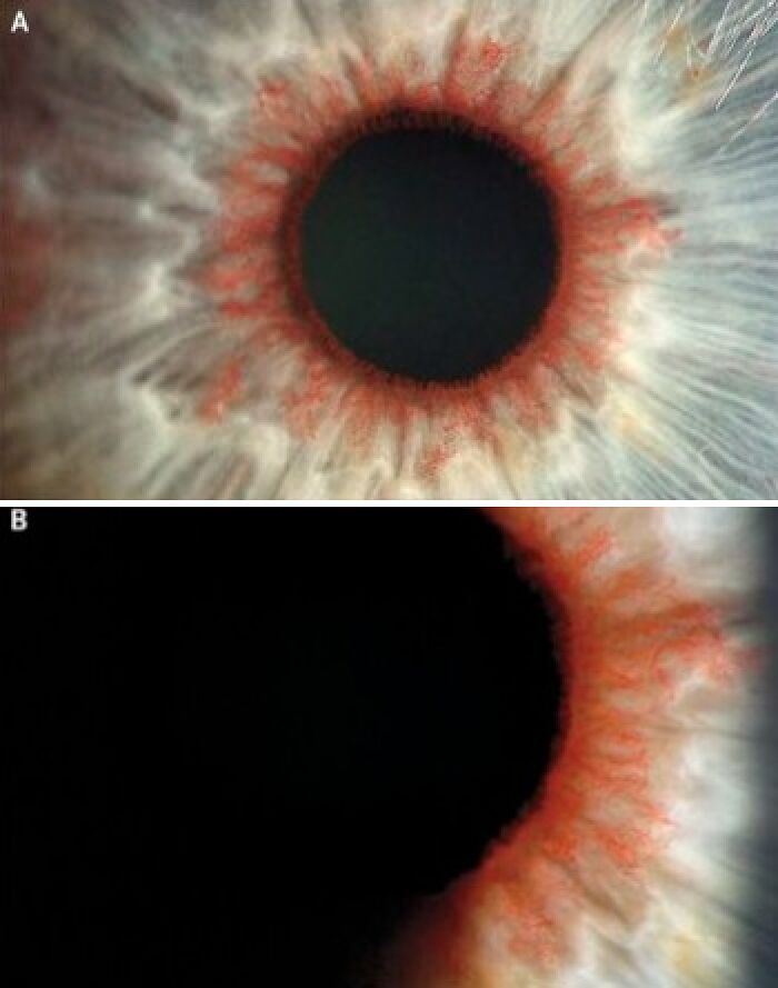 Close-up medical photos showing detailed vascular structures of the eye's iris in high magnification.