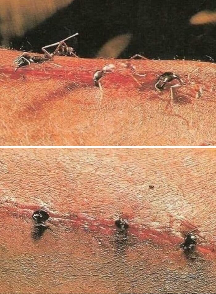 Close-up medical photos showing ants attracted to an open wound on human skin with red, irritated flesh.