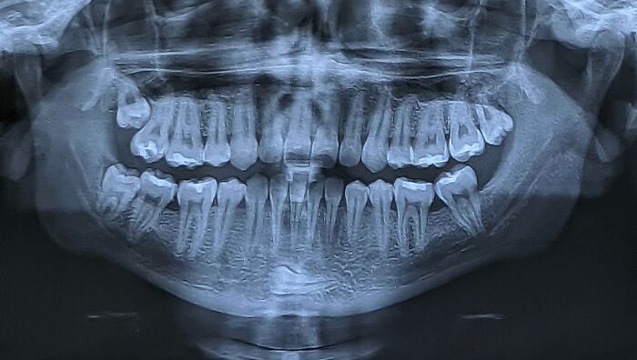 Panoramic dental X-ray showing detailed teeth structure and jawbones, a fascinating medical photo revealing oral anatomy.