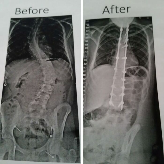 X-ray images showing spine before and after surgical correction with metal rods, a medical photo revealing spinal treatment.