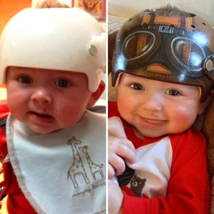 Side-by-side images of a baby wearing medical helmets used for cranial correction in medical photos.