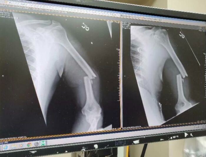 X-ray images showing a severe broken arm fracture, highlighting medical photos that are both fascinating and disturbing.