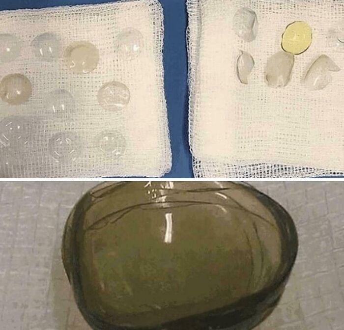 Clear and ruptured breast implants shown on gauze pads in a medical photo illustrating fascinating and disturbing medical photos.
