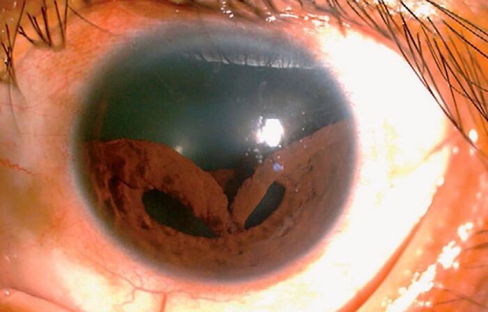 Close-up medical photo of an eye showing detailed iris and pupil with unusual brownish deposits inside the cornea.