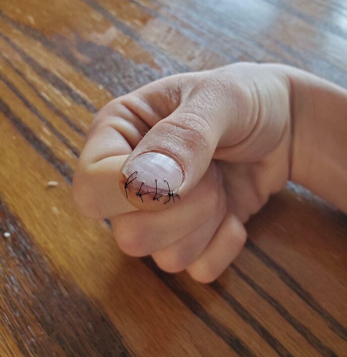 Close-up of thumb with medical stitches along the nail in a raw and disturbing medical photo.