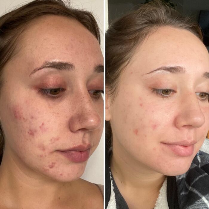 Side-by-side photos showing reduced acne and clearer skin, illustrating low-effort products tackling high-anxiety body issues.