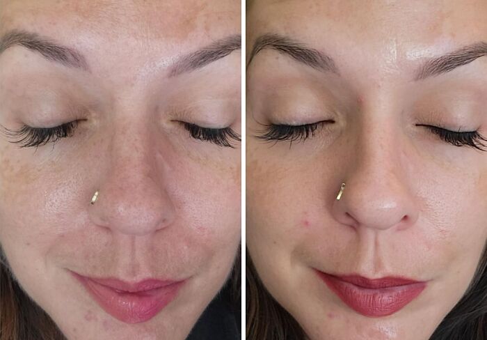 Close-up comparison of a woman's face before and after using low-effort products addressing high-anxiety body issues.