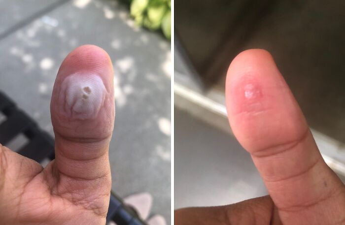 Close-up of a thumb with skin issues before and after using low-effort products for high-anxiety body concerns.