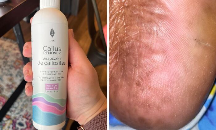 Hand holding a bottle of callus remover next to a close-up of a dry, c*****d heel, addressing high-anxiety body issues.