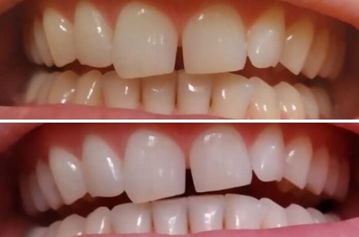 Close-up comparison of teeth before and after using low-effort products to tackle high-anxiety body issues with improved appearance.