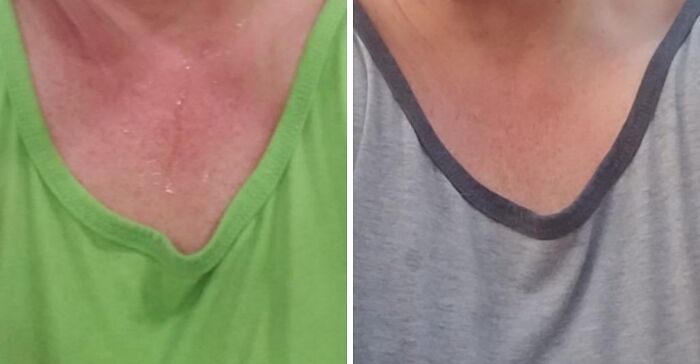Close-up comparison of skin redness and irritation on chest before and after using low-effort products for anxiety body issues.