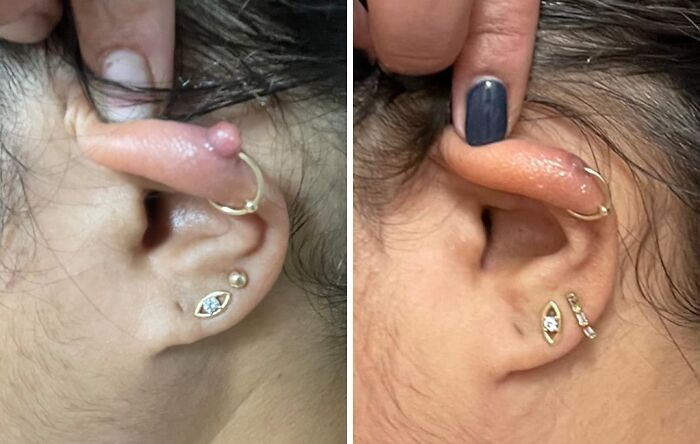 Close-up of ear showing skin bumps before and after treatment using low-effort products for high-anxiety body issues.