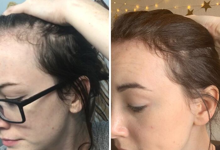Before and after photos showing improved hairline with low-effort products tackling high-anxiety body issues.