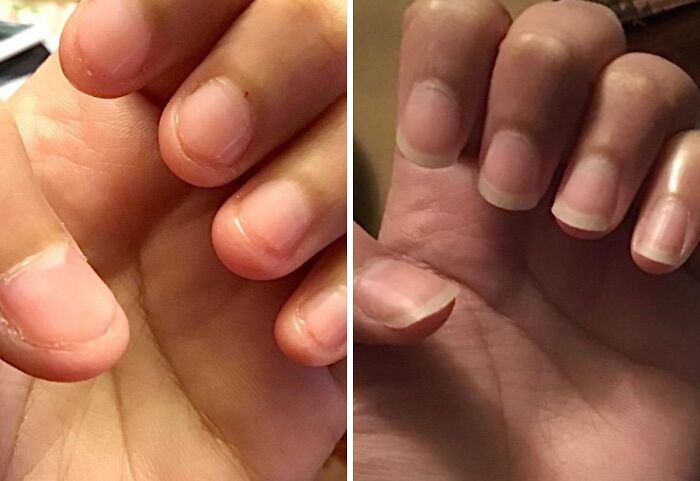 Close-up comparison of hands showing nail care results as a low-effort product for high-anxiety body issues.