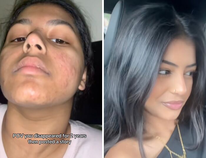 Before and after images of a woman showing clear skin, representing people returning to social media after a hiatus.