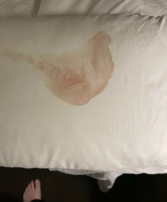Stained hotel pillowcase showing a large reddish-brown mark, highlighting one of the times hotels messed up badly.