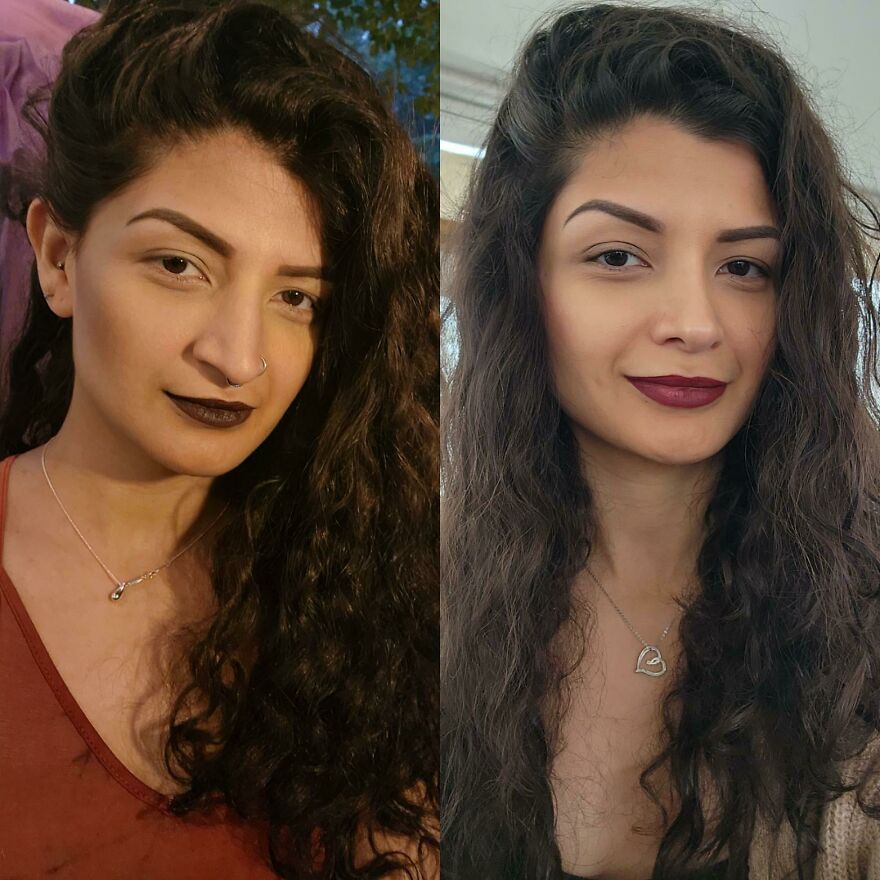 Comparaci&oacute;n antes y despu&eacute;s de rinoplastia primaria a los 9 meses, mostrando reducci&oacute;n de inflamaci&oacute;n y resultado exitoso.