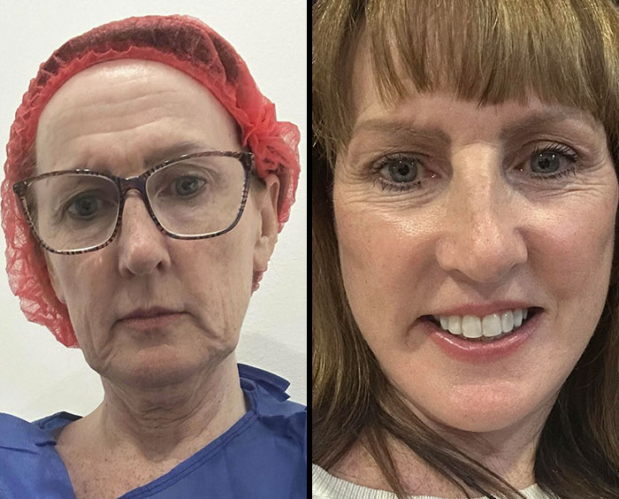 Before and after plastic surgery transformation showing dramatic facial rejuvenation in Beverly Hills housewife look.