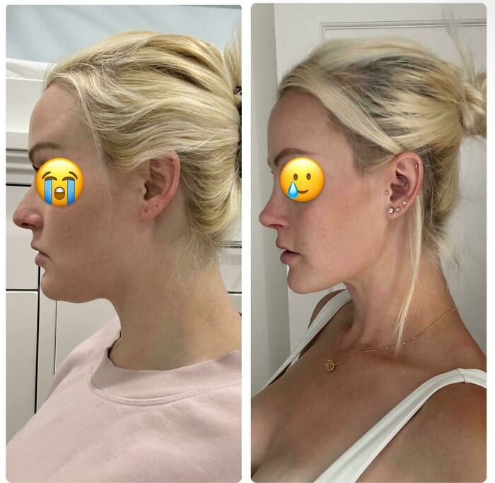Side-by-side before and after plastic surgery photos showing facial transformation of a woman with blonde hair.