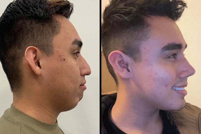 Side-by-side before and after plastic surgery photos showing a man’s facial transformation and improved profile appearance.