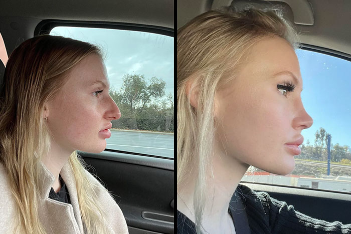 Side-by-side before and after plastic surgery photos showing a woman’s profile transformation in a car.