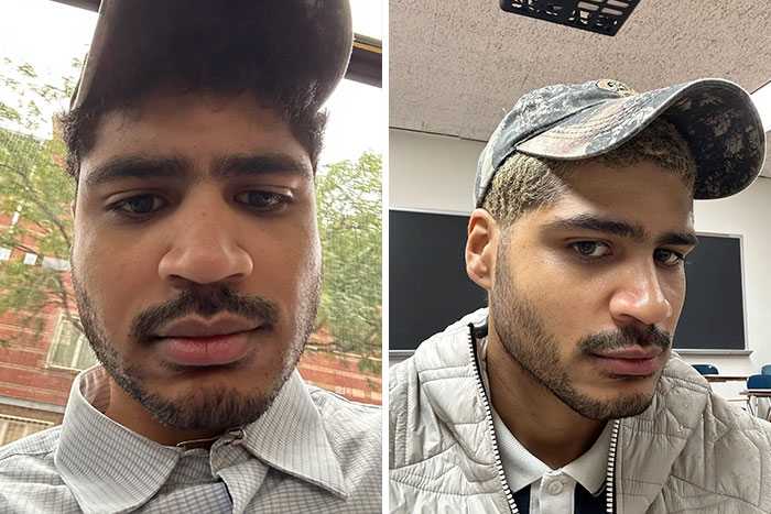 Before and after plastic surgery transformation showing significant facial changes in a young man’s appearance.