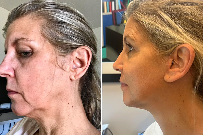 Before and after plastic surgery transformation photos showing a woman's improved profile and youthful appearance.