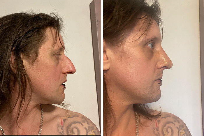 Side-by-side before and after plastic surgery photos showing facial transformation with improved profile and contour.