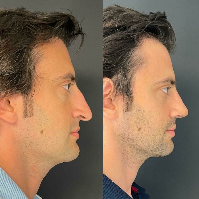 Before and after plastic surgery side profile comparison of a man showing facial transformation results.