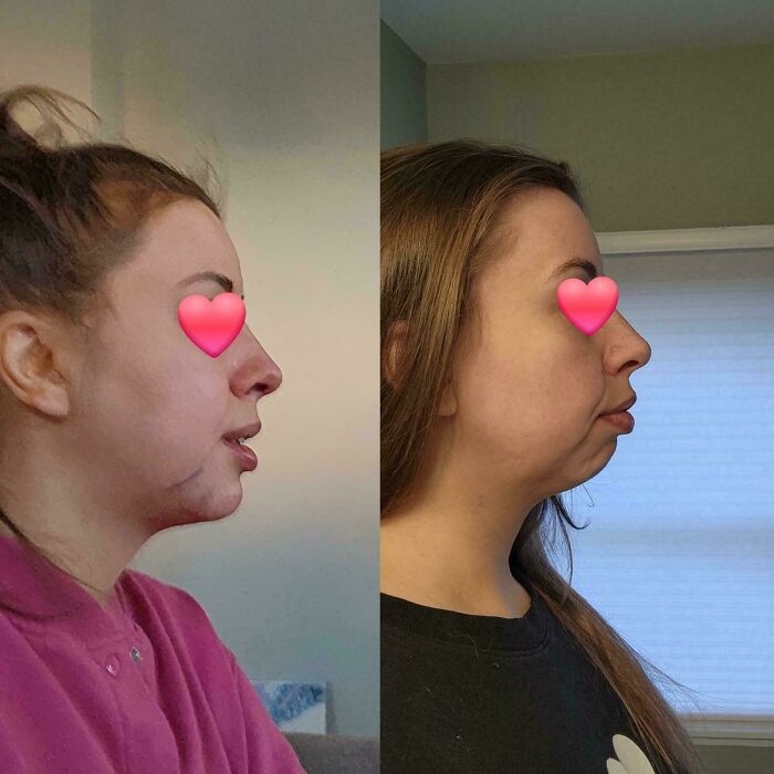 Before and after plastic surgery pics showing side profile transformation from mom at Costco to Beverly Hills housewife.