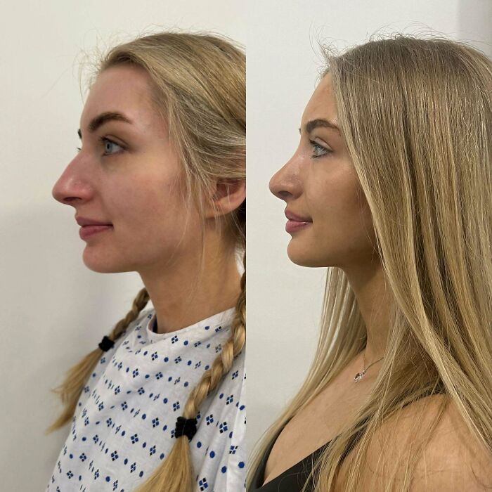 Before and after plastic surgery profile of a woman showing transformation in Beverly Hills housewife style.