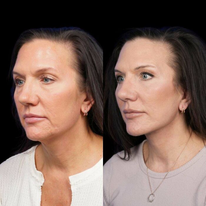 Side-by-side before and after plastic surgery photos of a woman showing facial transformation and rejuvenation.