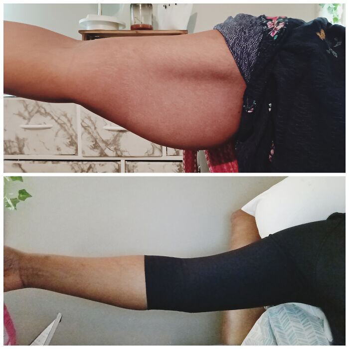 Before and after plastic surgery arm transformation showing significant toning and contouring results.