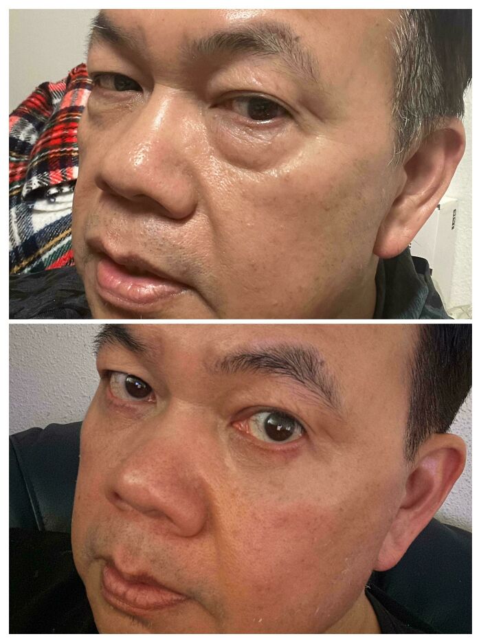 Before and after plastic surgery photos showing visible facial improvements and smoother skin texture on a middle-aged man.