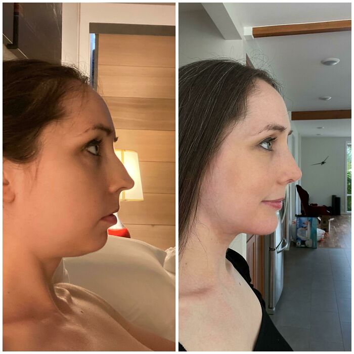 Before and after plastic surgery profile photos of a woman showing changes in nose and chin in a home setting.