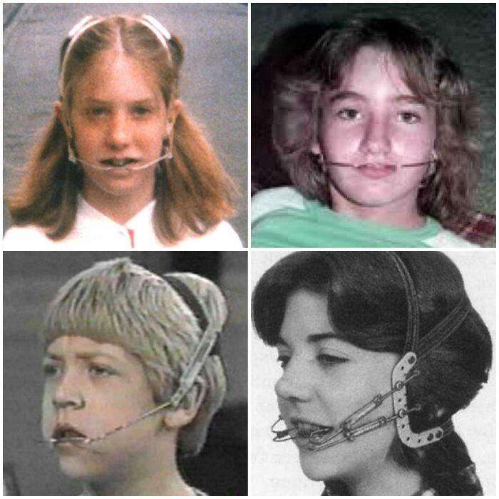 Collage of vintage orthodontic braces worn by children, illustrating nostalgic things that make people feel very old.