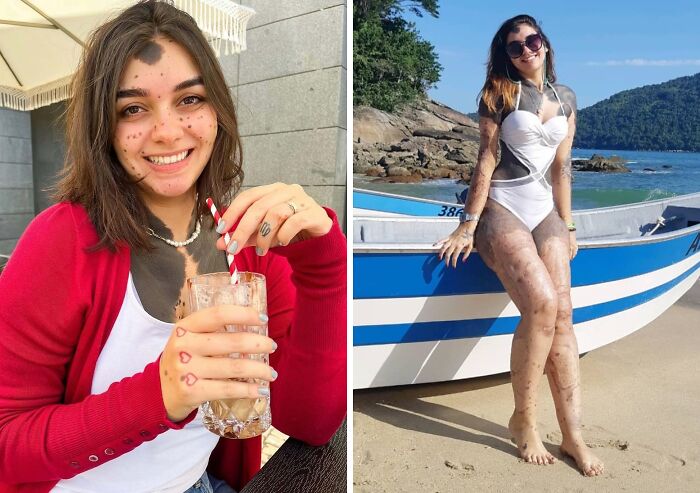 Young woman with multiple interesting birth marks on her face, arms, and legs, smiling indoors and posing on a beach.