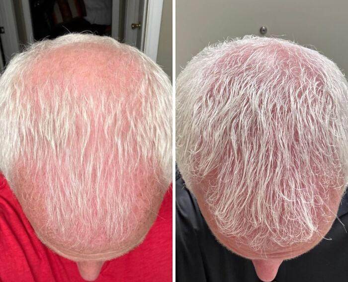 Top view of a scalp showing before and after results of hair products featured in favorite problem solvers under 15 dollars.