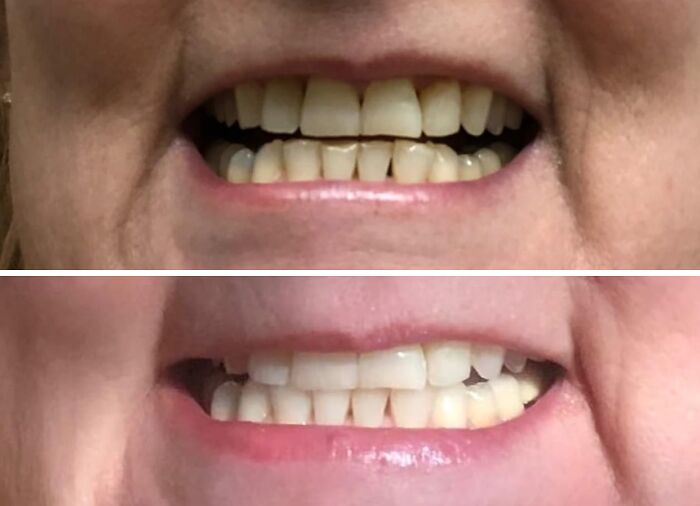 Before and after close-up images showing teeth improvement as a favorite problem solver under $15 solution.
