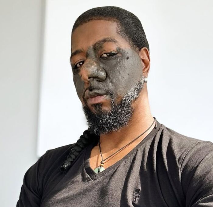 Man with unique and interesting birth marks covering part of his face, photographed in natural light.