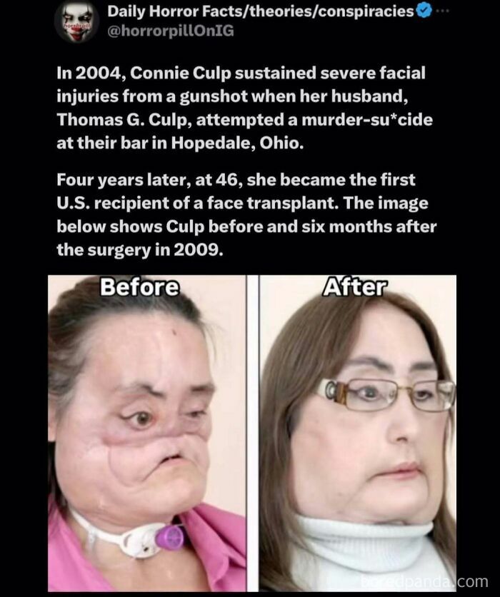 Before and after images of severe facial injuries and transplant surgery featured in unsettling horror pill online group post.
