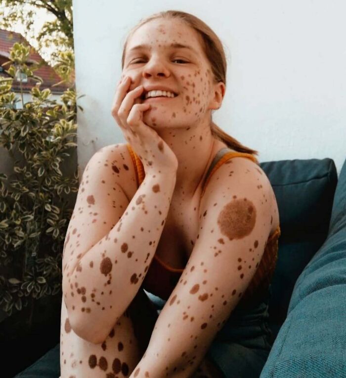 Young woman with unique and interesting birth marks covering her face, arms, and shoulder, smiling and seated indoors.